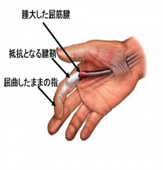 バネ指の詳細画像